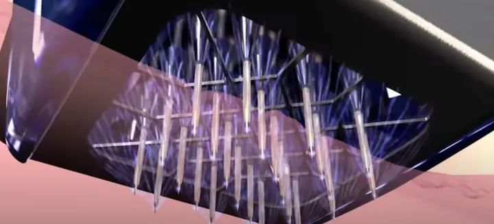 Illustration showing the Morpheus8 microneedle array
